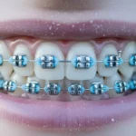 Braces Colors for Winter